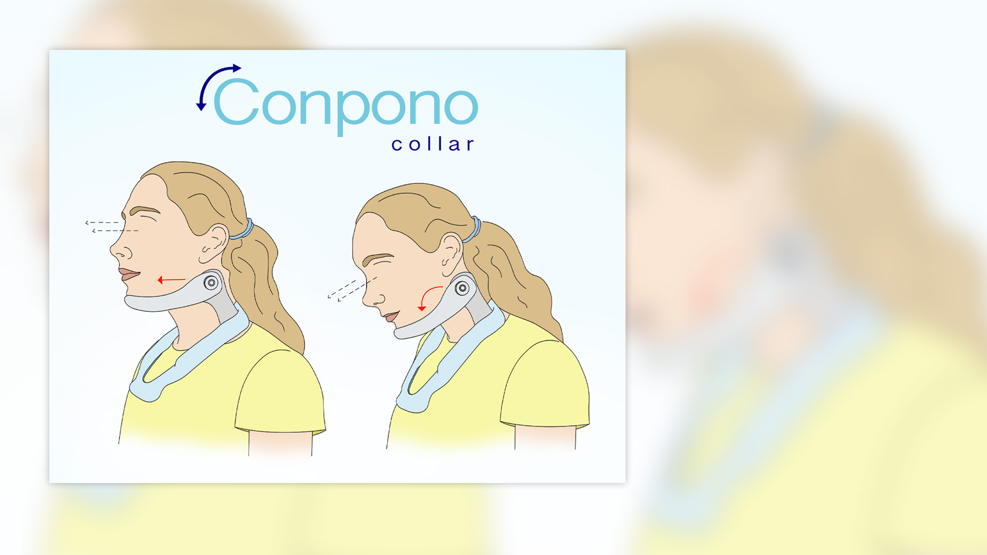 An illustration of the Conpono Collar featuring a depiction of a patient wearing the collar while looking straight ahead on the left and another depiction of the patient looking down on the right, demonstrating the range of motion afforded by wearing it.